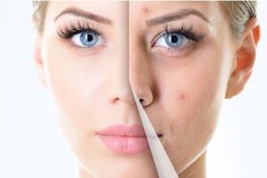 Acne-treatment-and-prevention-Antigua-Regent-Park